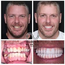 Image result for dental implant