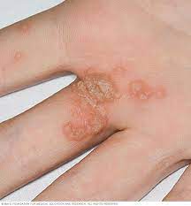 A prospective study in spain // bmc infect. Hpv Infection Symptoms And Causes Mayo Clinic