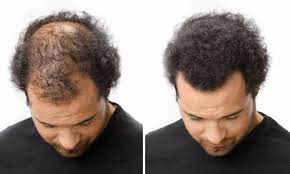 It can be sprayed on and is resistant to wind, sweat, and mild rain. 10 Best Hair Fibers Concealers Reviewed 2020 Too Manly