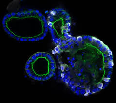 These patients have severe disease and are associated with a poor prognosis. Coronavirus Sars Cov 2 Infects Intestinal Cells Study Finds Lab Manager