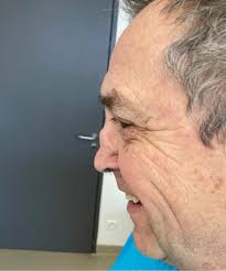 Saddle Nose Deformity in Sarcoidosis