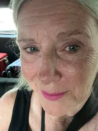 Dengue fever day five- My head & body are in pain. My skin looks deep red &  splotchy. What's good? I ate for the first time in five days-a delicious  traditional Balinese