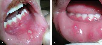 It can also be transmitted from oral or skin surfaces that appear. Nongenital Herpes Simplex Virus American Family Physician