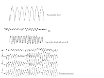 Image result for what is the treatment for v-tach