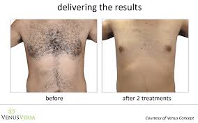 The lumbar laser may be similar to the bikini line and armpit laser, causing pain in this area and causing tenderness. Laser Hair Removal Green Bay Ambiance Md Medical Spa