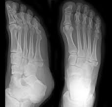 These injuries occur when the foot is twisted. Ortho Review Keepin Up With The Joneses Brown Emergency Medicine