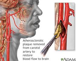 Image result for carotid artery