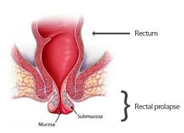 Image result for Rectal prolapse
