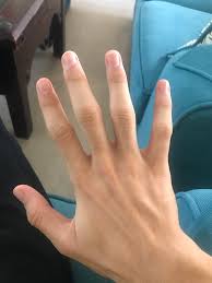 We already know the outcome, just clip my fingers. Does Taping Your Fingers Give You Bjj Fingers Or Not Cuz I Feel The Pressured Tape Is What Shapes The Finger That Way Yellow Belt Bjj