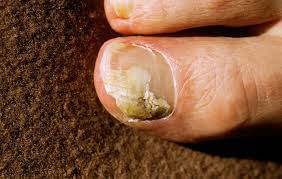 Toenail fungus, also known as onychomycosis is the most commonly caused infection. 6 Natural Ways To Defeat Toenail Fungus Runner S World