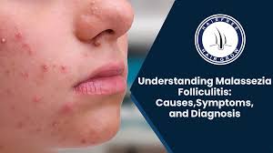 Image result for folliculitis symptoms