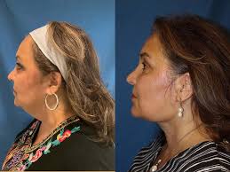 Santa Barbara Neck Lift Surgery