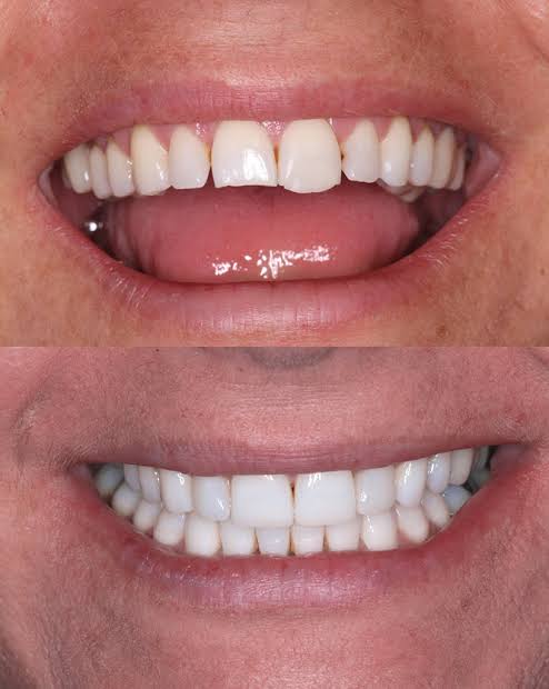 What is Composite Bonding? - Y Bont Faen Dental Centre