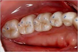 The silver filling is also known as amalgam filling, and it may take 24 hours to get stable. What Are Fillings Smileinsight Dental San Diego Ca