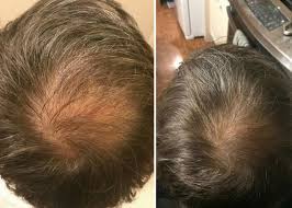 It gets right inside your hair itself and helps address lots of concerns directly. Diy Essential Oil Blend For Hair Growth It Really Works Coconut Oil Hair Growth Treatment Coconut Oil Hair Hair Growth Treatment