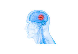 Jan 31, 2020 · a stroke, sometimes called a brain attack, occurs when something blocks blood supply to part of the brain or when a blood vessel in the brain bursts. New Medical Device May Improve Recovery For Stroke Victims