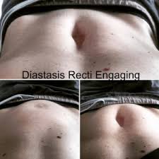 5 Effective Diastasis Recti Exercises Laurenohayon Com