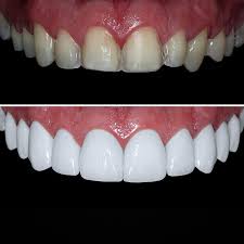 Porcelain Veneers on Harley Street | Pro Dental Clinic
