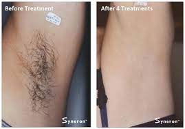 You can expect to see about a 10% to 25% reduction in hair after your first treatment. Is Laser Hair Removal Effective On Legs
