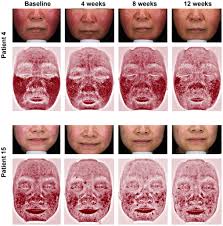 Acne and rosacea have in common several possible treatments including but not limited to oral antibiotics topical antibiotics sulfa based face washes isotretinoin and many others. Retrospective Analysis Of 19 Papulopustular Rosacea Cases Treated With Oral Minocycline And Supramolecular Salicylic Acid 30 Chemical Peels