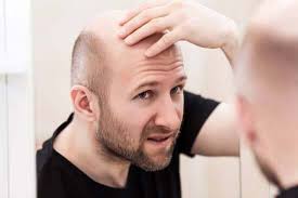 Many people have issues with volum. Balding Can Hair Grow Back After Balding Man Matters