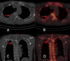 To begin streaming 98.5, select the play button below and get the ultimate boston sports experience on 98.5! Added Value Of Hybrid Spect With Ct Imaging For Predicting Poor Therapeutic Efficacy Of 89 Sr In Patients With Bone Metastasis Scientific Reports