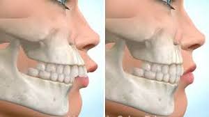 How to correct overbite without braces. How Do Braces Fix Overbites Premier Orthodontics
