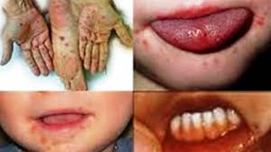 Infeksi virus merupakan penyakit infeksi yang disebabkan oleh masuknya virus ke dalam tubuh manusia. Baru Dari Negeri Singa Waspada Flu Singapura Dan Kenali Ciri Ciri Ini Halaman All Tribun Batam