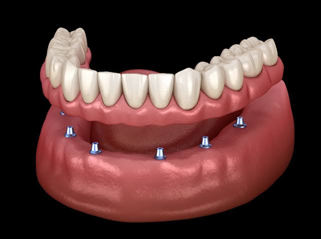 Partial and Complete Dentures care 2