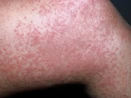 Image result for allergy rash on the legs