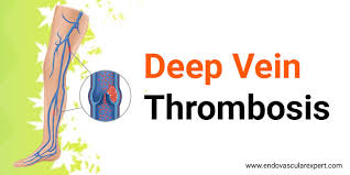 Symptoms can include pain, swelling, redness, and enlarged veins in the affected area. Dvt Treatment In Jaipur By Dr Nikhil Bansal Deep Vein Thrombosis