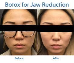 You can easily determine whether a celebrity has botox or not. Botox For Jaw Reduction The Dermatology Specialists