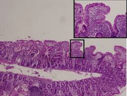 Image result for Intestinal Enteropathy