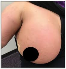 Image result for Inflammatory breast cancer