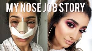 This is especially important when it comes to restoring the overall balance and symmetry of your face. My Nose Job Surgery Story And Vlog Cost And Experience Youtube