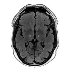 Image result for Thalamotomy