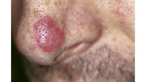 This means they began in the milk ducts. Peau D Orange Is It Breast Cancer Or Something Else