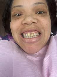 Temporary fix for large white teeth