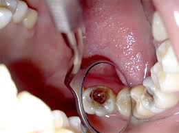 Image result for Pulpitis