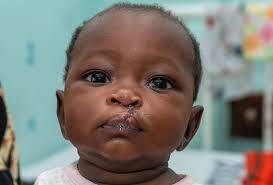 Cleft Nutrition Care Is Saving Lives in Tanzania