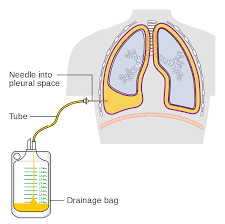 Lesen sie mehr zum pneumothorax: Pleurapunktion Wikipedia