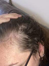 In men, hair loss usually begins above the temples, and the receding hairline eventually forms a characteristic m shape; Hair Loss I Have Developed Thinning Hair On The Left Side Of My Head I Have Naturally Curly Hair Styles Naturally Hairstyles For Thin Hair Curly Hair Styles