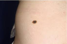 It starts in the basal layer and spreads horizontally for months to years before it invades into the dermis. Pdf Abrupt Intralesional Color Change On Dermoscopy As A New Indicator Of Early Superficial Spreading Melanoma In A Japanese Woman Semantic Scholar