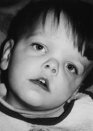 The Ocular Manifestations of Jacobsen Syndrome: A Report of Four Cases and  a Review of the Literature