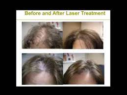 Red light therapy for hair loss or… Red Light Therapy For Hair Growth Does It Work