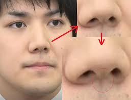 整形手術で縫った痕の傷みたい 口になんか食べカスもついてるし 整形手術 内親王 小室