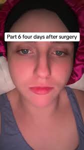 How to Sit After Inguial Hernia Repair