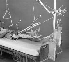 University of minnesota health brand represents a collaboration. Femoral And Tibial Traction Pins Wheeless Textbook Of Orthopaedics