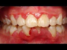 Book in for regular professional teeth cleaning with your general dentist. 3 Easy Ways To Get Rid Of Gum Swelling How To Get Rid Of Swollen Gums Natural Remedies Youtube Swollen Gum Swollen Gums Remedy Gum Disease Remedies