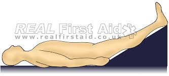 Left lateral recumbent position synonyms, left lateral recumbent position pronunciation, left lateral recumbent position translation, english dictionary definition of left lateral recumbent position. Casualty Positioning Real First Aid